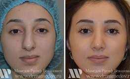 Фото до и после удаления горбинки и коррекция кончика носа