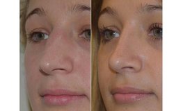 Фото до и после изменения носа динамичной риноскульптурой