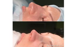 Фото до и после операции динамичная риноскульптура носа