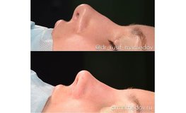 Фото до и после операции динамичная риноскульптура на носу 