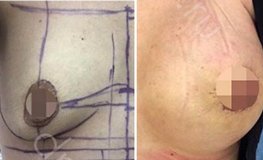Фото до и после эндопротезирования молочных желез круглыми имплантами 325 сс
