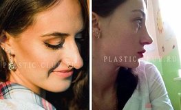 Фото до и после пластики носа
