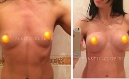 Фото до и после увеличивающей маммопластики имплантатами Политех 350 мл