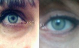 Фото до и после блефаропластики