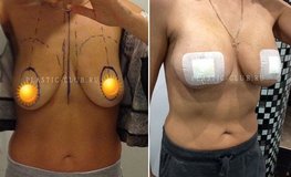 Фото до и после маммопластики имплантатами Mentor объемом 300 мл с подтяжкой