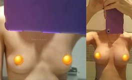 Фото до и после маммопластики грудными имплантатами Natrelle 295 мл