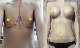 Фото до и после увеличения груди с объемом имплантатов 295 мл