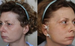 Фото до и после операции по подтяжке средней трети лица