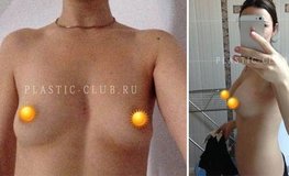 Фото до и после маммопластики грудными имплантатами с объемом 450 мл