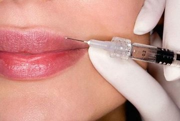 Увеличение губ: липофилинг или гиалуроновая кислота