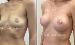 Фото до и после увеличения груди с установкой имплантата под мышцу