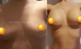 Фото до и после маммопластики для ассиметричной груди