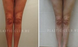 Фото до и после пластики голени