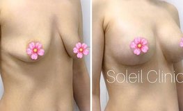 Фото до и после одномоментной мастопексии с увеличением груди