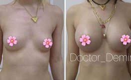 Фото до и после аугментационной увеличивающей пластики груди