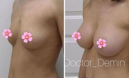Фото до и после увеличения груди без эффекта «пуш-ап»