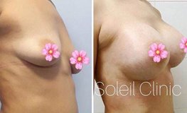 Фото до и после мастопексии с установкой имплантатов объемом 385 мл