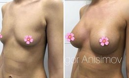 Фото до и после коррекции объема и формы груди