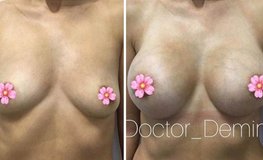 Фото до и после пластики с ареолярной подтяжкой груди