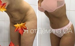 Фото до и после абдоминопластики после родов