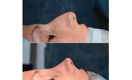 Фото до и после атравматичной методики пластики носа