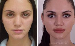 Фото до и после пластики носа по закрытой методике