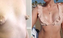 Фото до и после пластики на тубулярной груди