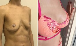 Фото до и после увеличения груди с 3D подтяжкой