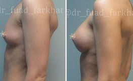 Фото до и после установки круглых имплантатов в грудь