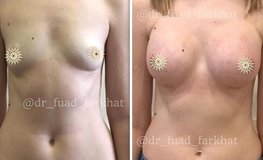 Фото до и после увеличения груди по методике 