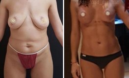 Фото до и после подтяжки груди и липомоделирования живота