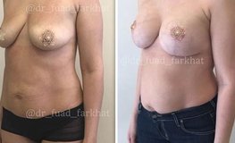 Фото до и после увеличения груди с удалением избытка кожи