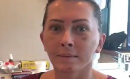 Видео отзыва пациентки после омоложения лица с липофилингом