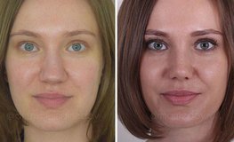 Фото до и после атравматичной закрытой пластики носа