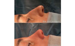 Фото до и после операции атравматичная закрытая пластика носа