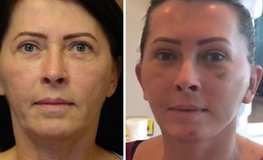 Фото до и после пластики по омоложению лица с липофилингом