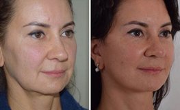 Фото до и после подтяжки нижней зоны шеи и лица