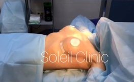 Видео результата после окончания аугментационной маммопластики
