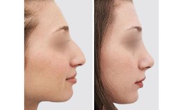 Фото до и после моделирования хрящей, кончика и перегородки носа