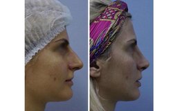 Фото до и после моделирования кончика, хрящей и перегородки носа