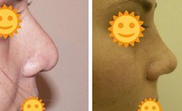 Фото до и после повторной ринопластики на кончике носа