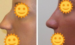 Фото до и после удаления горбинки на носу