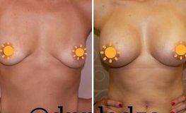 Фото до и после композитного увеличения груди