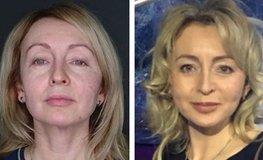 Фото до и после мини-лифтинга лица