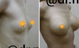 Фото до и после композитного увеличения груди