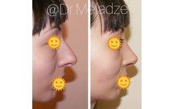 Фото до и после сентопластики носа