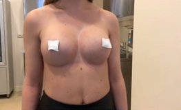 Видео результата увеличения груди круглыми имплантатами