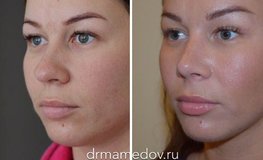 Фото до и после комплексной операции лица