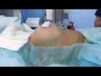 Фуад Фархат - Результат маммопластики сразу после операции, доктор Фуад Фархат
