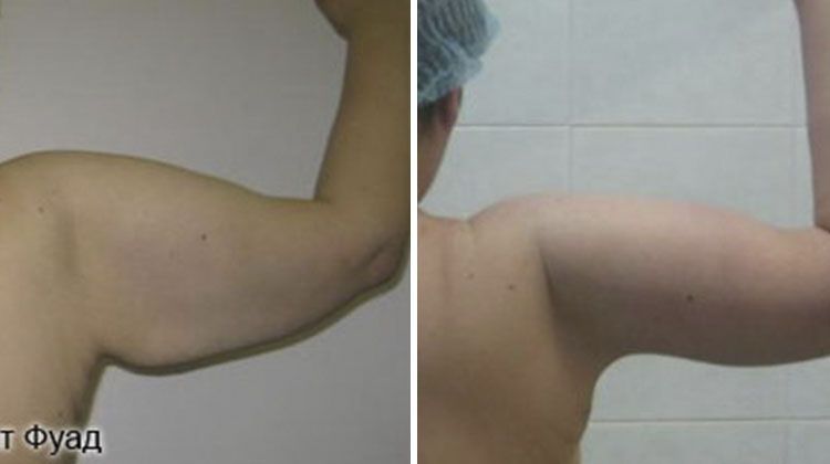Результаты после липосакции плеч, пациент 38 лет, пластический хирург Фархат Фуад Ахмедович